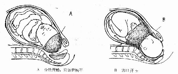临床执业医师考试妇科学辅导:第一产程的临床