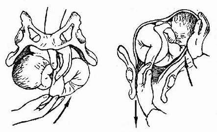 临床执业医师考试妇科学辅导:内外联合倒转臀