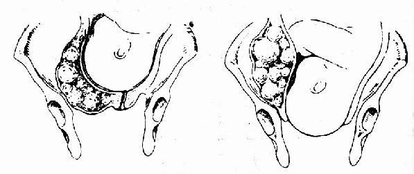 临床执业医师考试妇科学辅导:软产道异常 _ 临
