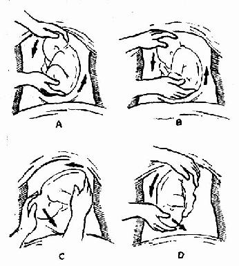 胎儿异常--臀位