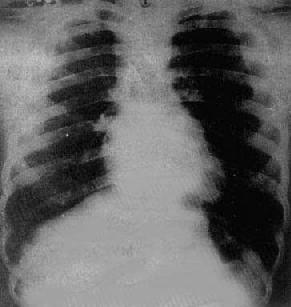 Fallot����֢