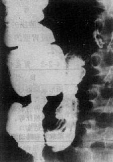 实践技能医师医学影像学:胃肠道病症X线表现与