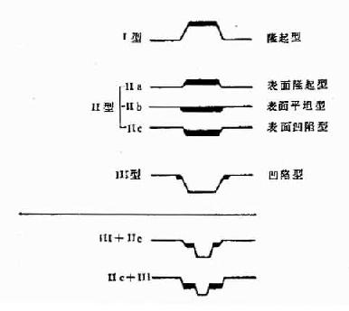 表4-2-1+早期胃癌分型