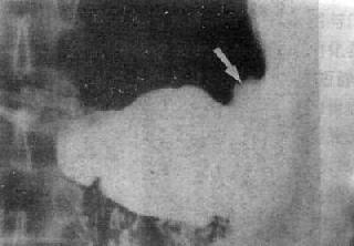 胃角部突出腔外的龛影(↓)