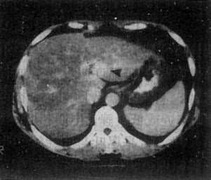 实践技能医师医学影像学:肝的CT与MRI诊断
