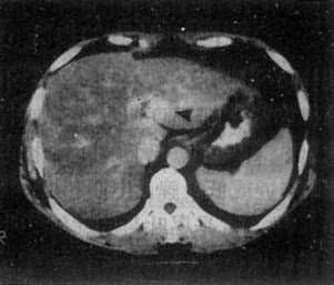 实践技能医师医学影像学:肝的CT与MRI诊断
