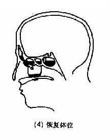 临床执业医师考试外科学辅导:慢性化脓性鼻窦