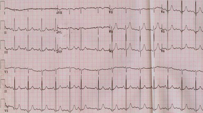 临床执业医师实践技能考试(第三站):心电图辅导