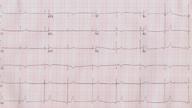 临床执业医师实践技能考试(第三站):心电图辅导6-医师实践技能-考试大