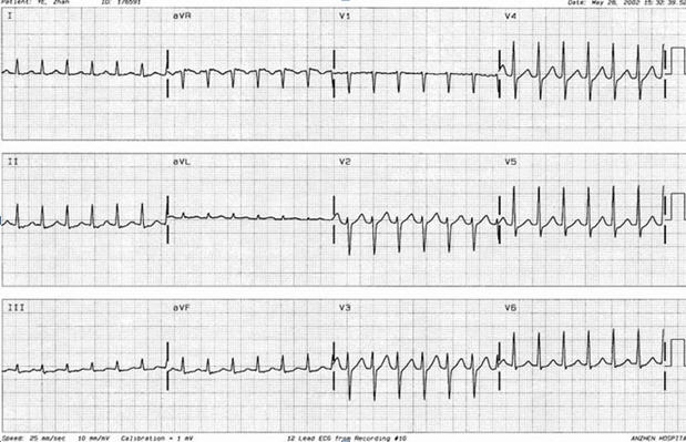 临床执业医师实践技能考试(第三站):心电图辅导