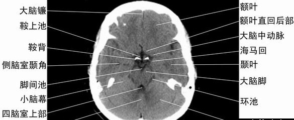 2015年实践技能医学影像学考点:左肾上腺嗜铬